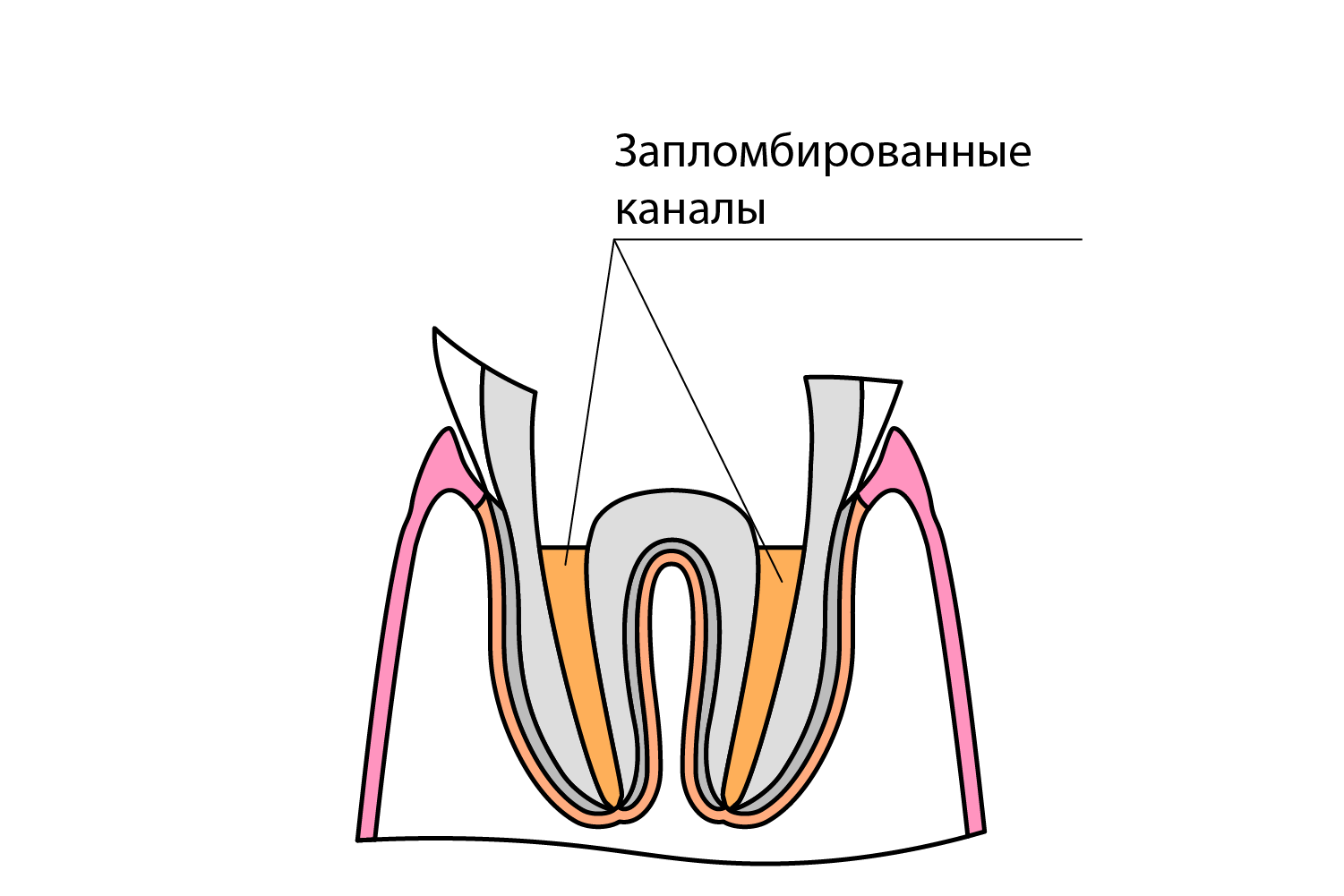 Пломбировка корневых каналов. Материал для восстановления культи зуба.